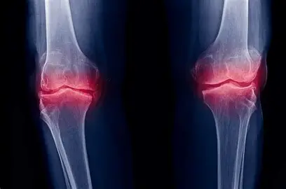 Knee Pain